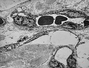 F,42y. | pseudoangiomatous hyperplasia F,42y. | pseudoangiomatous hyperplasia